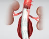 Aneurismas da aortaCirurgia/Stents/Endopróteses