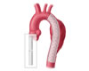 Dissecções da AortaCirurgia/Stents/Endovascular