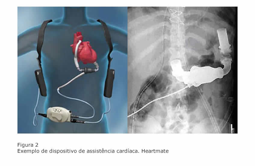 dispositivo-assistencia-cardiaca-heartmate