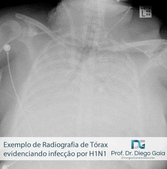 radiografia-infeccao-h1n1.jpg