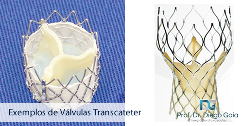exemplos-valvula-transcateter